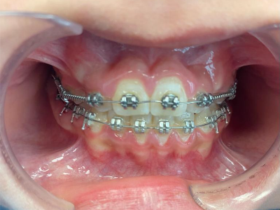 after case 4